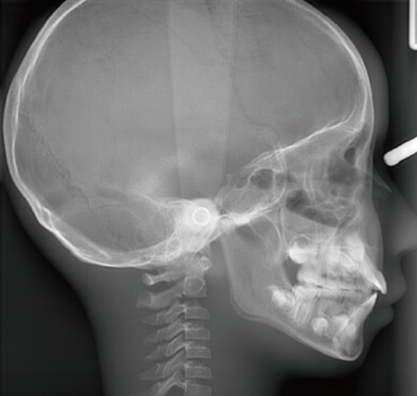 矯正の精密検査、セファロ(頭部X線規格写真)について