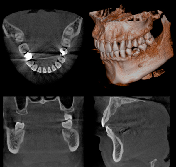 治療の安全性と正確性の向上、より質の高い医療のための歯科用CTについて