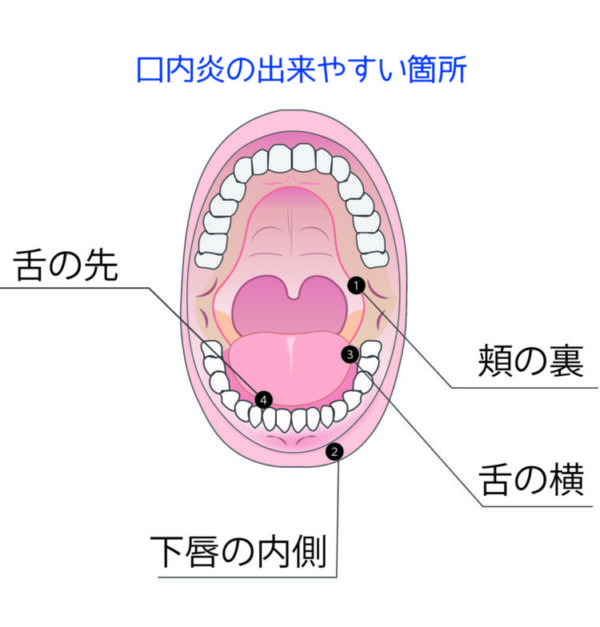 もの 舌 原因 でき 舌苔（ぜったい）とは？ 舌の白い付着物が起こすトラブルやケア方法を解説