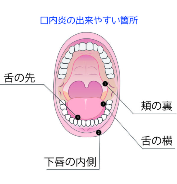 口内炎 治ら ない