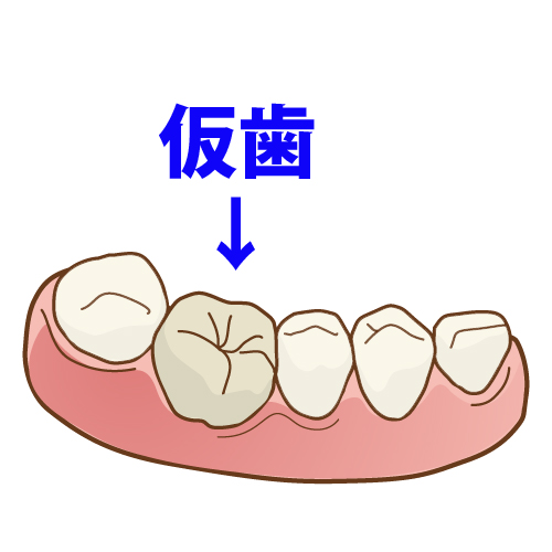 仮歯が治療のクオリティーを左右する？｜歯科の豆知識｜京都市中京区の歯科｜たけち歯科クリニック