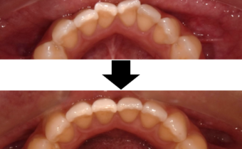 マウスピース矯正・劇的Before→After！